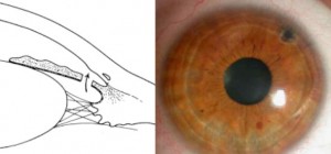 Augenzentrum_Iridotomie
